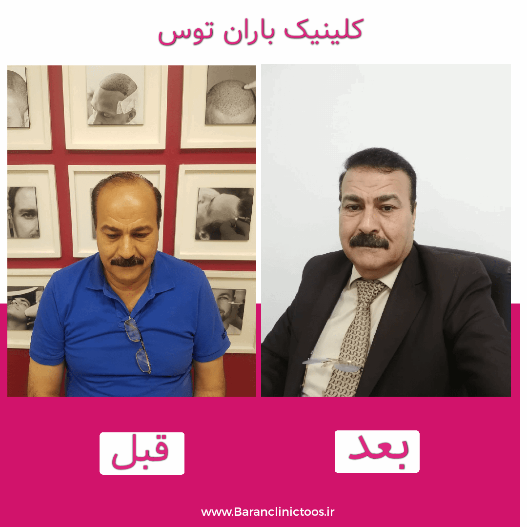 قبل و بعد کاشت مو